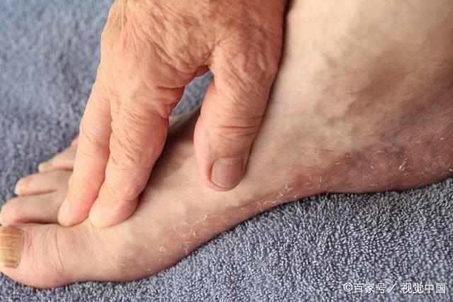 脚气病图片,脚气病症状与防治全解析
