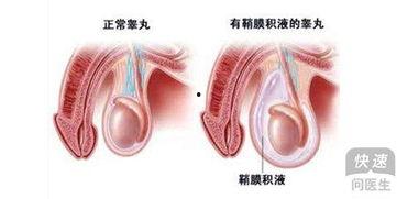 睾丸鞘膜积液手术视频,睾丸鞘膜积液手术全过程解析