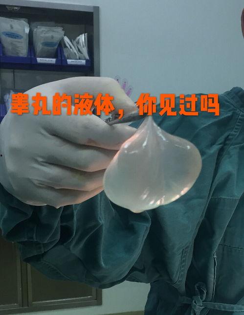 睾丸鞘膜积液手术视频,睾丸鞘膜积液手术全过程解析