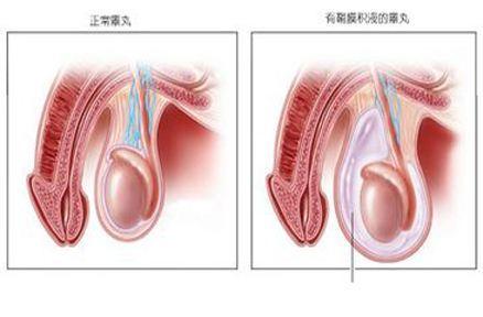 睾丸鞘膜积液手术视频,睾丸鞘膜积液手术全过程解析