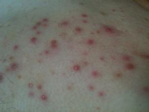 女性梅毒病看图片大全,女性梅毒病症状图解与防治要点