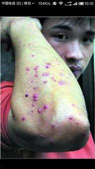 女性梅毒病看图片大全,女性梅毒病症状图解与防治要点