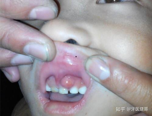 牙龈长脓包图片,视觉识别与应对策略