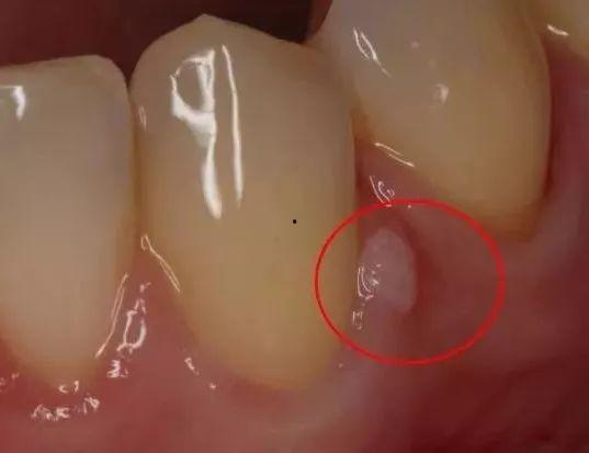 牙龈长脓包图片,视觉识别与应对策略