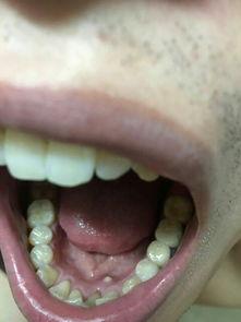 牙龈长脓包图片,视觉识别与应对策略