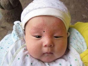 黄水疮图片,揭秘皮肤感染疾病的典型症状与防治措施