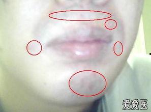 黄水疮图片,揭秘皮肤感染疾病的典型症状与防治措施