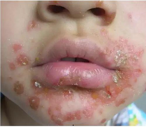 黄水疮图片,揭秘皮肤感染疾病的典型症状与防治措施