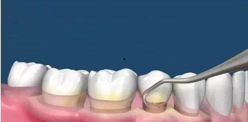 洗牙视频全过程,从准备到结束的全方位体验