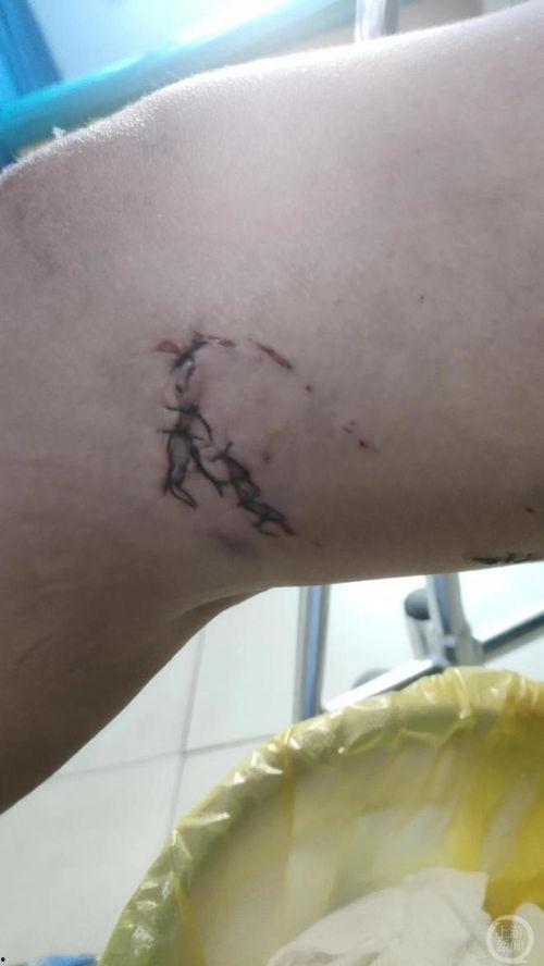 伤口的图片,图解伤口愈合全貌