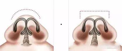 蒜头鼻图片大全,揭秘不同角度下的蒜头鼻风采