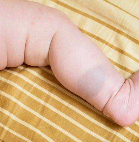 激光胎记后结痂图片,激光治疗胎记后结痂过程解析